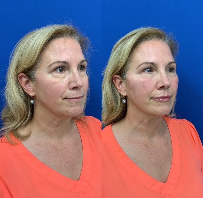 patient before and after with under-eye filler