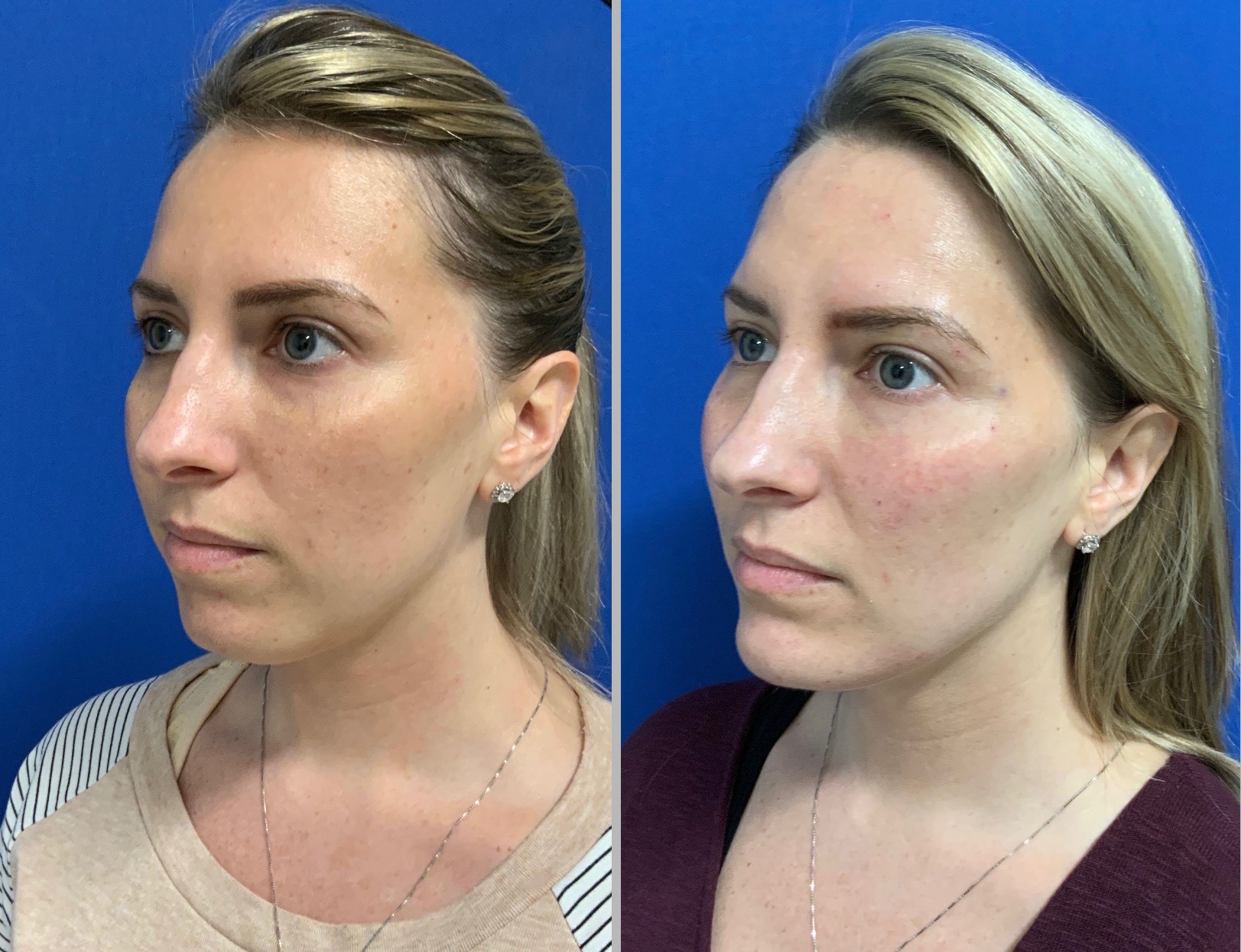 Jawline enhancement chin augmentation with filler