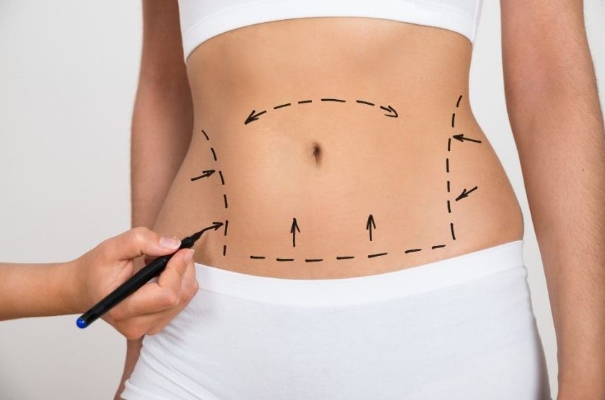 tummy tuck