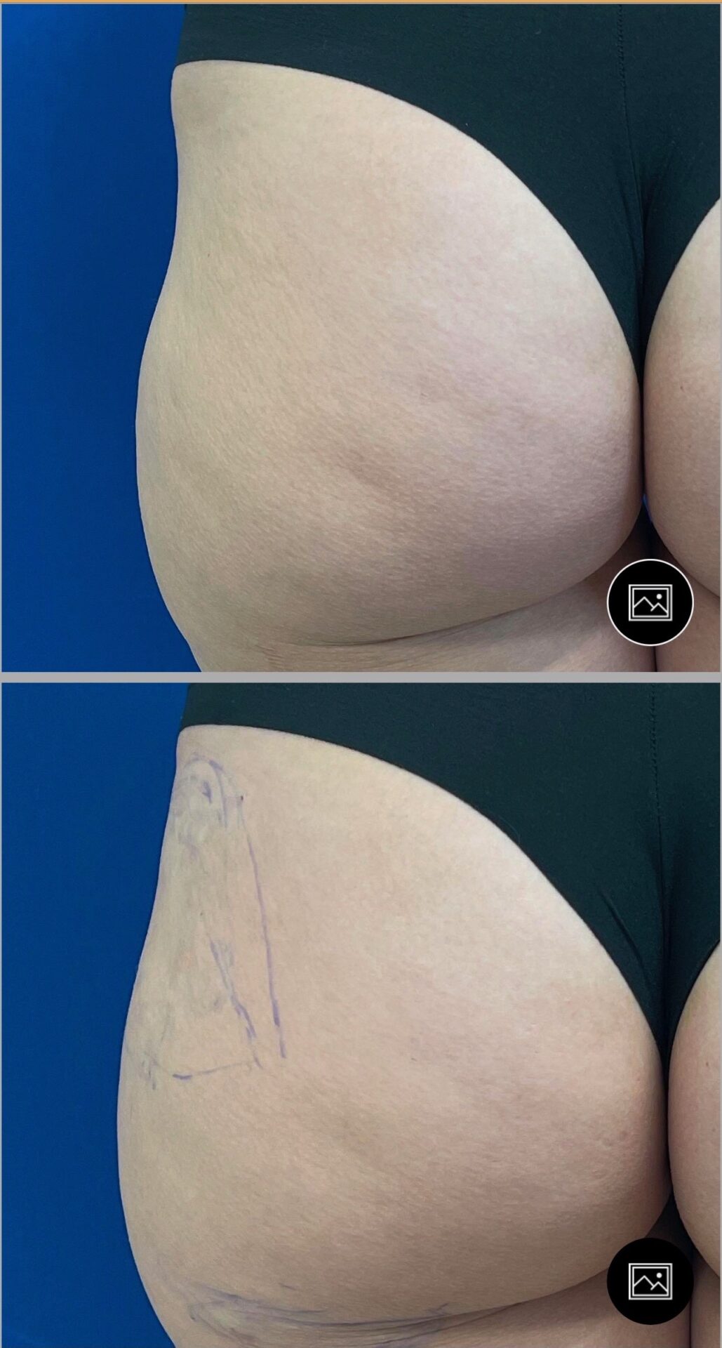 Woman getting Nonsurgical Butt Lift with Filler